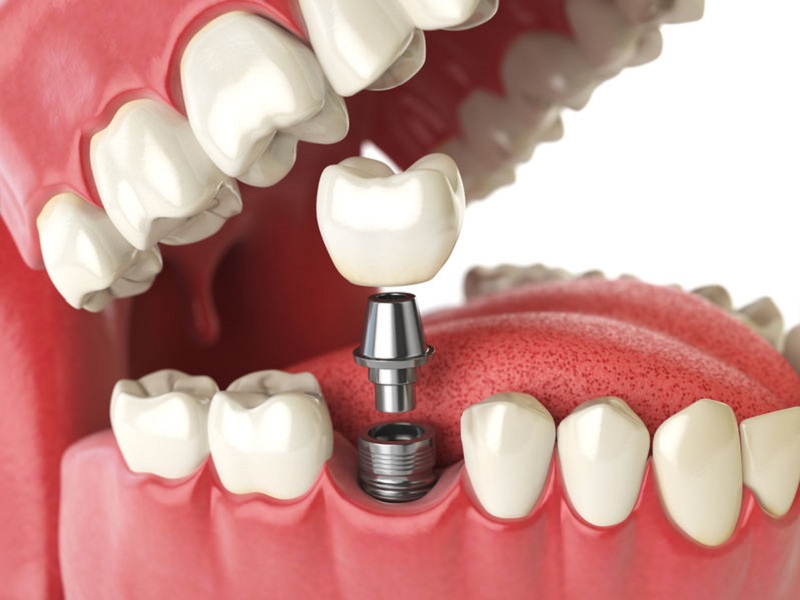 Implanty zębów Raszyn